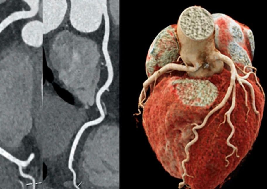 Grupo Vidah - Coronárias